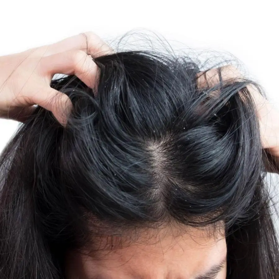Łojotokowe zapalenie skóry – choroba, która niszczy włosy